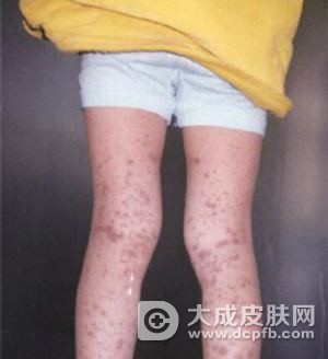 过敏性紫癜的原因
