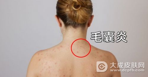 身上的毛囊炎怎么办
