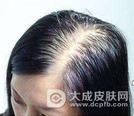 脂溢性脱发怎么办
