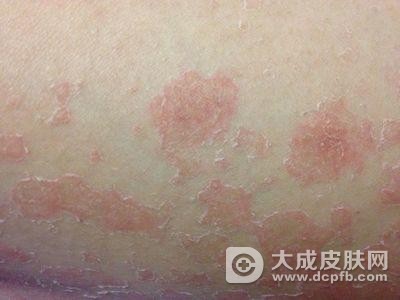 玫瑰糠疹对孩子的危害
