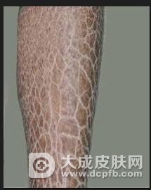 孩子得了鱼鳞病怎么办