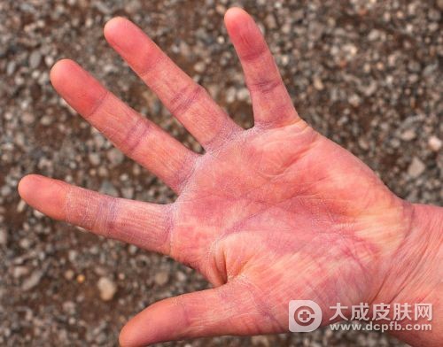 皲裂性湿疹怎么治疗好