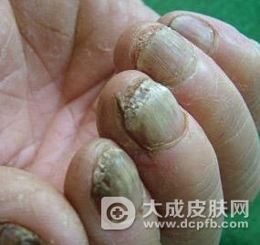 灰指甲为什么会增厚