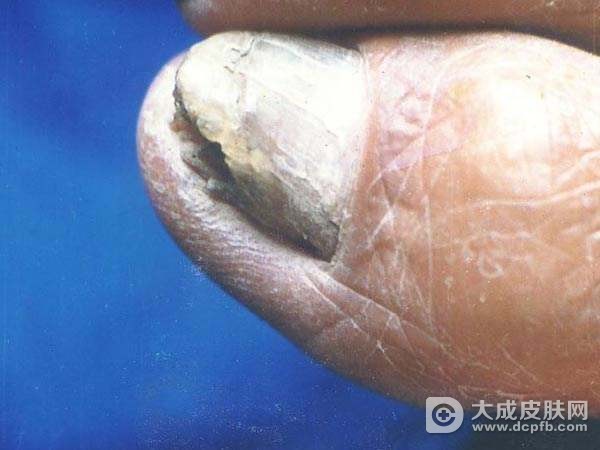 灰指甲用什么方法好
