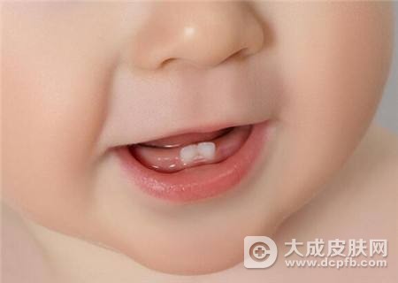鹅口疮的症状表现是什么