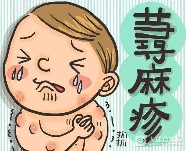 慢性荨麻疹好治吗