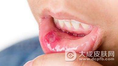 口腔溃疡是什么原因
