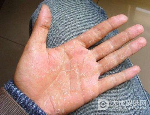 手上脱皮怎么办