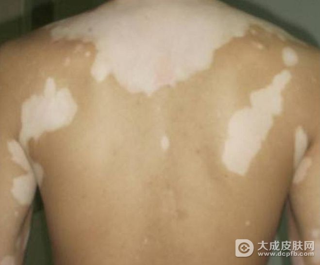 白癜风多久能治愈