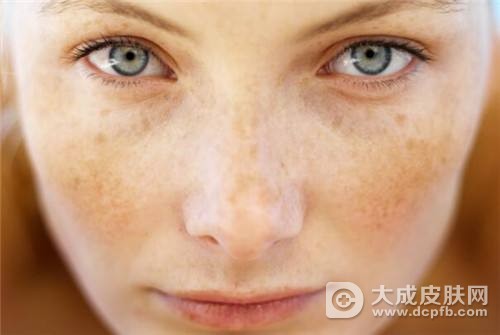 脸上的蝴蝶斑怎么治