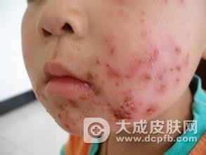 宝宝脓包疮的症状及治疗