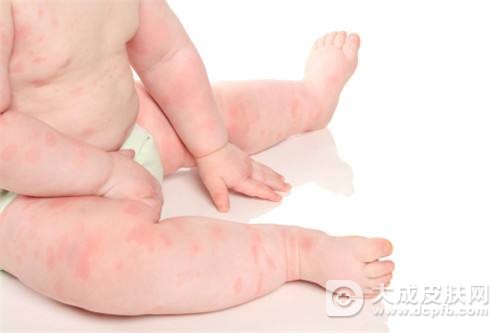 宝宝过敏是怎么回事