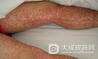 过敏性紫癜的预防