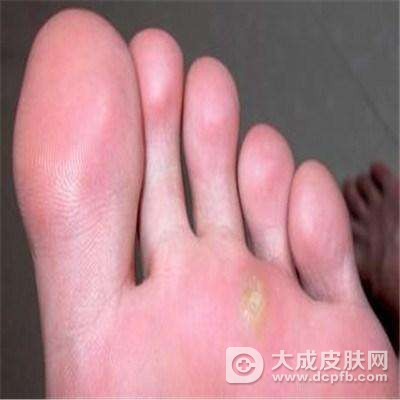 跖疣就是鸡眼吗