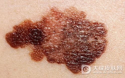 皮肤癌疾病会有什么症状表现