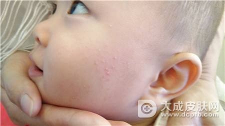 宝宝脸上长了湿疹怎么办