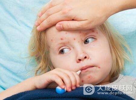 宝宝荨麻疹怎么办