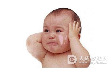 白斑就是白癜风吗