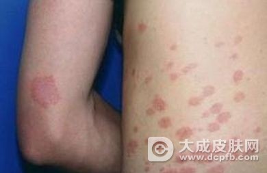 玫瑰糠疹病因