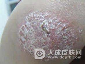 牛皮癣的症状表现是什么