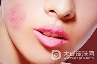 脸颊有红血丝怎么办