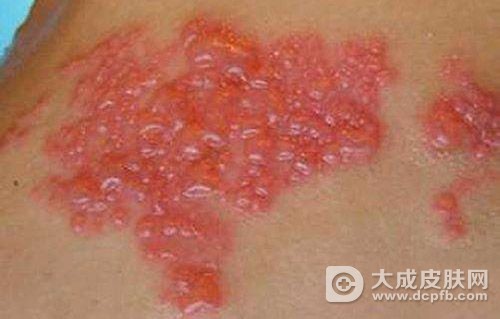 病毒性疱疹是怎么引起的