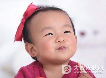 白色糠疹的症状及治疗