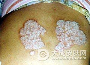 银屑病的护理方法