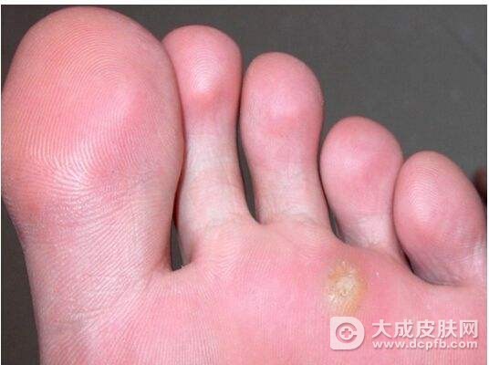 跖疣的能去除吗