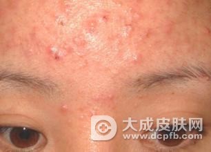 痘痘长满了怎么办