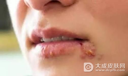嘴上起泡怎么回事