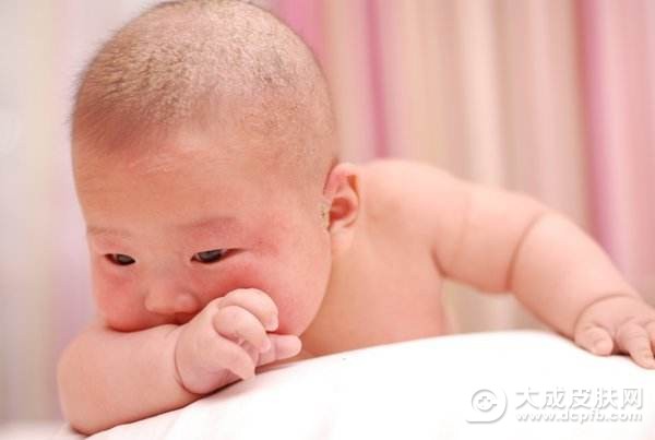 皮炎湿疹的病因