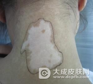 白癜风的危害及预防