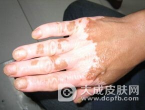 白癜风对人的危害