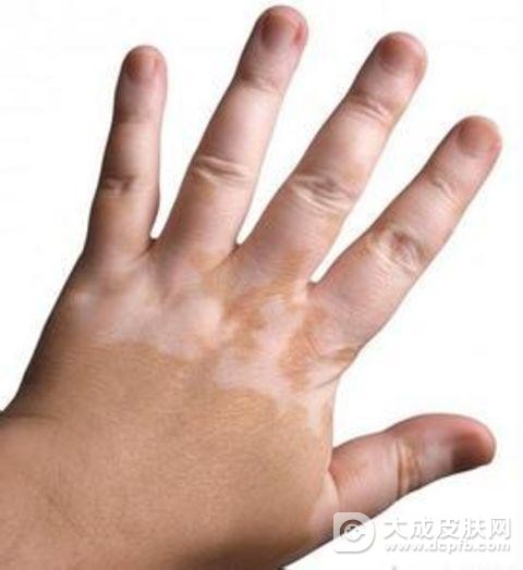 白癜风的早期症状及治疗方法