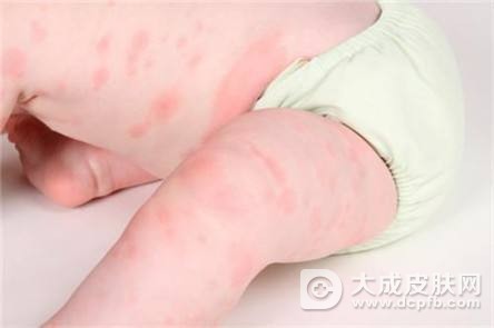 螨虫过敏怎么治疗