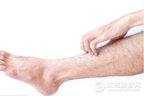 腿部的皮肤瘙痒要怎么办