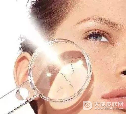 怎么预防紫外线过敏