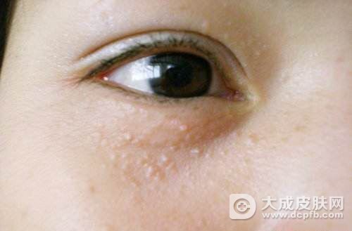 脸部有扁平疣怎么样护理好