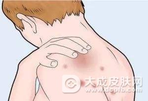 荨麻疹有什么忌口