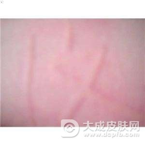 荨麻疹的治疗及护理
