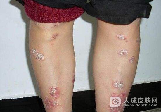 牛皮癣的症状