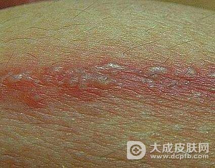 带状疱疹的护理注意哪些