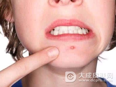 下巴一直长痘痘怎么办