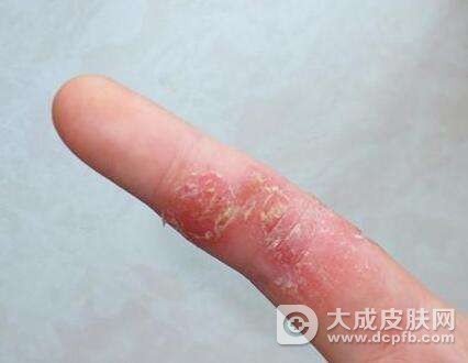 皮炎湿疹应该注意什么