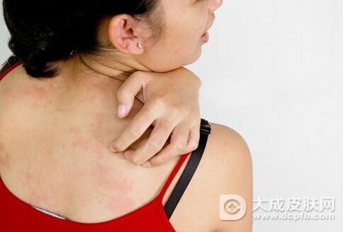 湿疹的症状有哪些