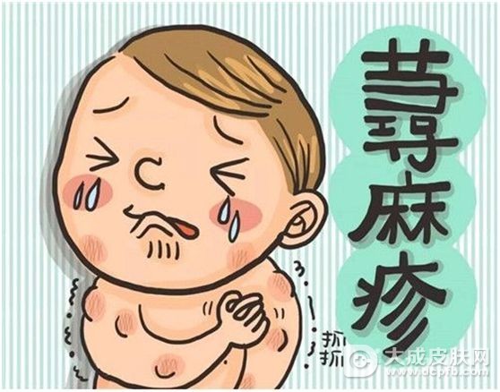 荨麻疹的饮食忌口