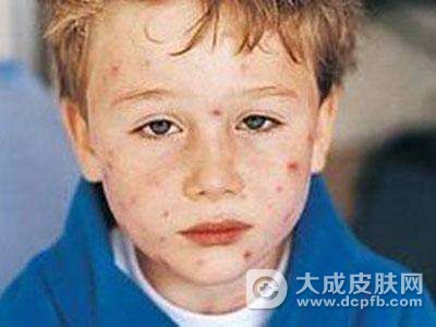 荨麻疹有什么需要忌口的