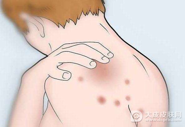 背上长痘的解决办法