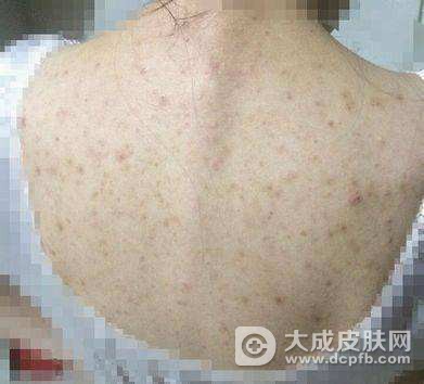 背上老长痘痘怎么回事